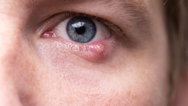 Detectan casos de conjuntivitis relacionados a enfermedades de transmisión sexual