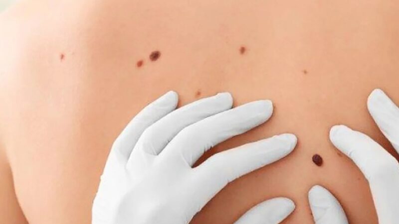 Campaña Nacional de detección de cáncer de piel: En Iguazú habrá chequeos de lunares
